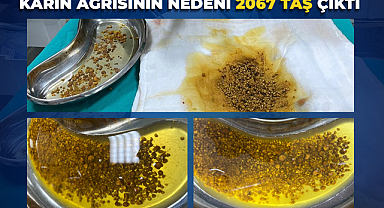 Karın Ağrısının Nedeni 2067 Taş Çıktı 
