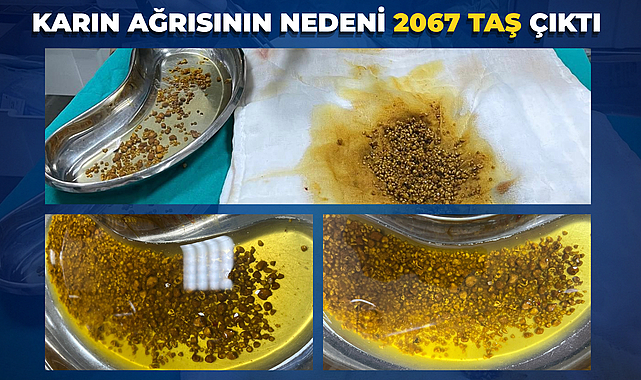 Karın Ağrısının Nedeni 2067 Taş Çıktı 